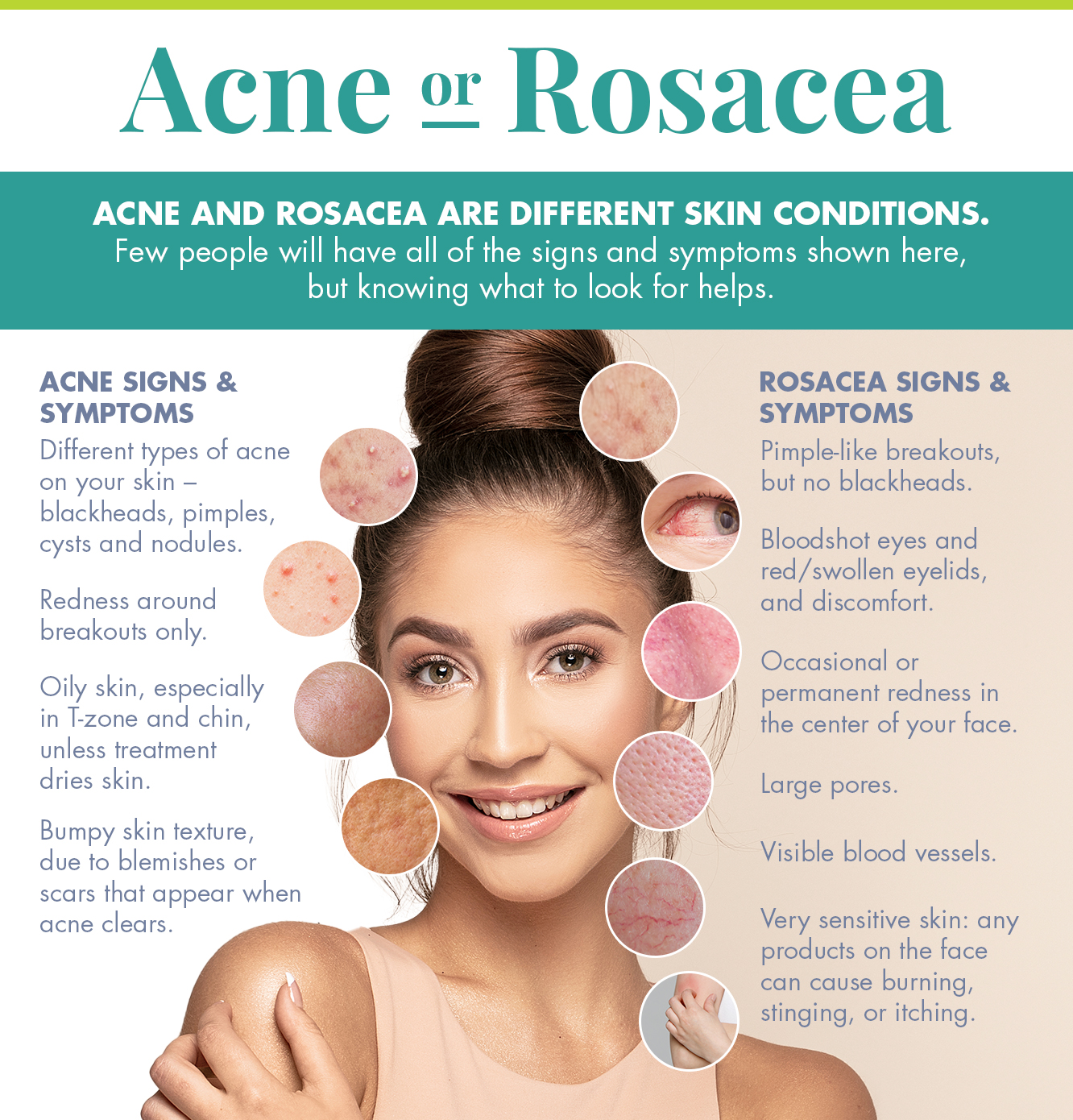 Acne OR Rosacea? The Differences Between These Skin Conditions ...